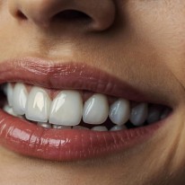 Hollywood Smile